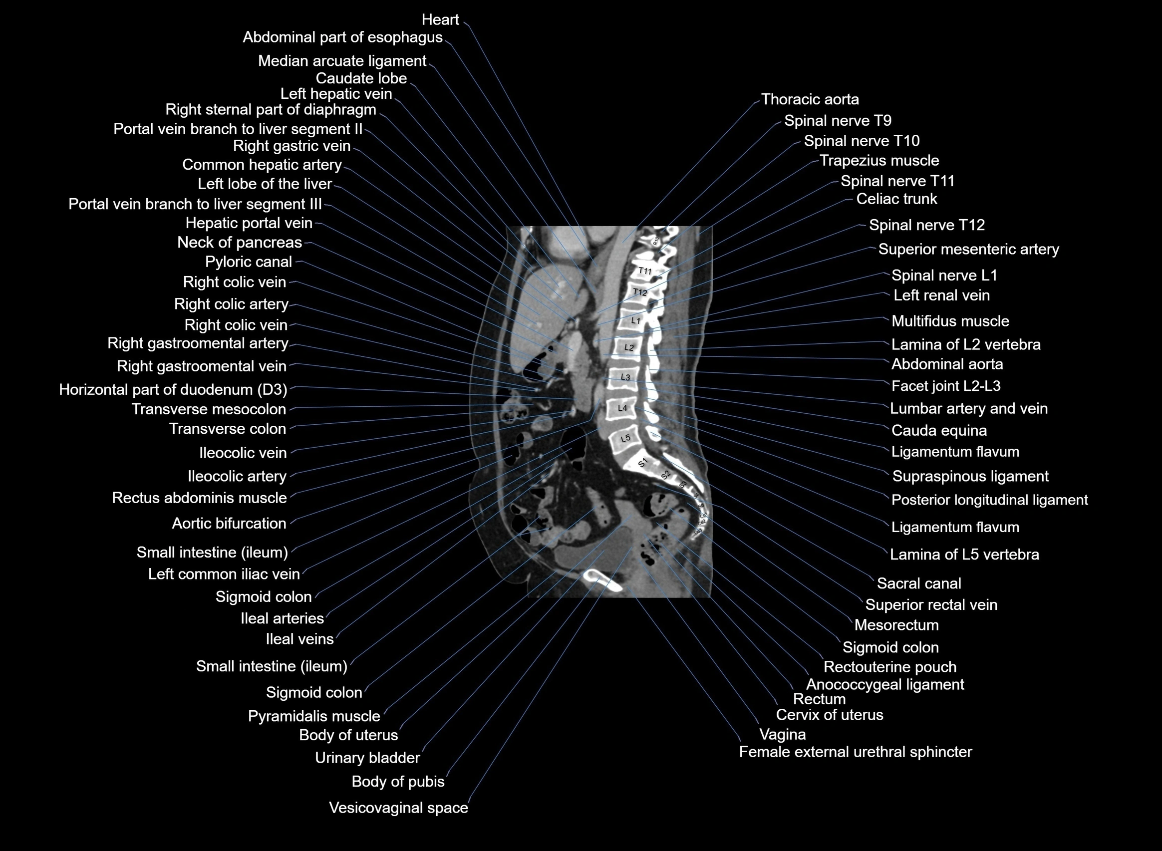 CT Abdomen sagittal cross sectional anatomy labelled radiology image -00059.webp
